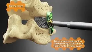 NanoHive Medical: Hive&trade; Standalone Cervical System