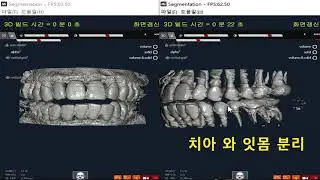 Semi Auto Tooth Segmentation Of Image Processing Base( from seed ct )