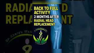Radial head replacement full recovery in 2 months #drgauravkhera #jointreplacement #doctor #hospital