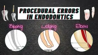 PROCEDURAL ERRORS IN ENDODONTICS || LEDGING || ZIPPING || ELBOW  #proceduralerrors #endo