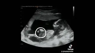Gender Reveal Ultrasound Explained at 14 Weeks 6 Days Pregnant