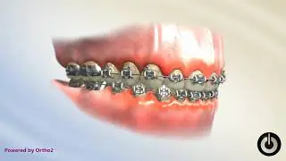 Poor Oral Hygiene White Spot Lesions