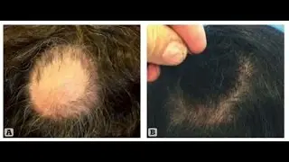 Grow Back Your Hair!!! AMAZING ACell + PRP Hair Regrowth, VIDEOS AND PICTURES