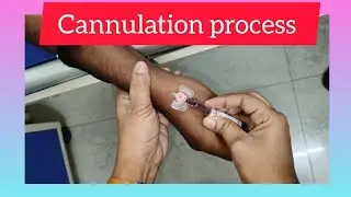 Cannulation techniques | cannula process #cannula #youtubevideo 