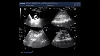 Ultrasound Video showing Shrunken kidney, with compensatory hypertrophy and intestinal obstruction.
