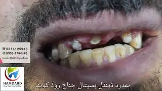 FixCrawn Natural Teeth, Hamdard Dental Complex Quetta. #dentalcare #dental #dentalimplants #quetta