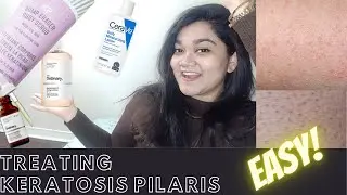 Routine for KERATOSIS PILARIS || Chicken Skin Treatment