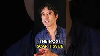 😨 FACELIFT SURGEONS ARE SCARING YOU 😨 SCULPTRA