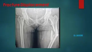 Fracture Displacement Made Easy