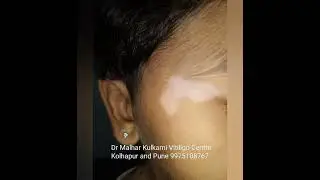 skin doctor white patch vitiligo centre