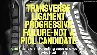 Transverse Ligament Failure