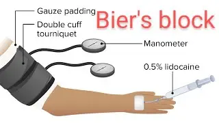 Intravenous regional anaesthesia in detail  #Bier'sblock #anesthesia #bams #surgery
