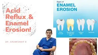 Acid Reflux & Its Effect on Teeth | Dr Arunkumar Pearls Dentistry | Dental Clinic Chennai |