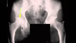 AVN Femoral Head on X ray