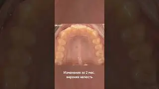 Прошло 2 месяца после установки брекет-системы