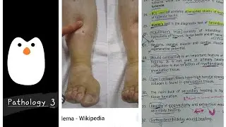 General Pathology Synopsis Part 3(Infacts& type , Edema and types)#dentalpulse #mds #pathology