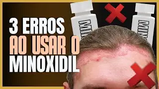 3 Erros Comuns ao Usar Minoxidil: Evite Armadilhas no Tratamento Capilar