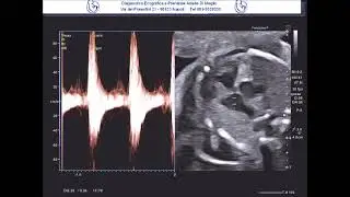 Estenosis pulmonar y anomalía de Ebstein