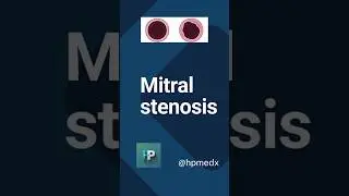 Mitral stenosis - snippets for medical students#MitralStenosis#CardiologyViva #MBBSViva#USMLETips