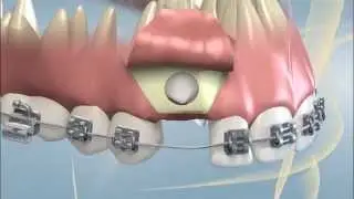 Impacted Canine