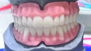 The FINAL update on DentKits dentures