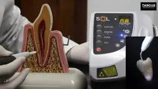 LÁSER SOL EN ENDODONCIA