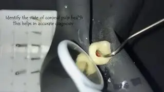 #accessopening #pulpotomy #pulpectomy how to do access opening in deciduous molars