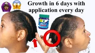 I GREW INCHES of HAIR WITHIN 6 DAYS Using VICKS VAPOUR RUB Everyday! Vicks vapour rub challenge