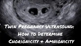 Twin Pregnancy Ultrasound: How to Determine Chorionicity & Amnionicity