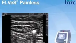 Laser 1470 BIOLITEC - Angiologia
