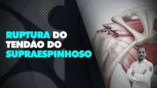 Ruptura do tendão do supraespinhoso