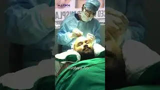 Hair Transplant in Indore | Marmm