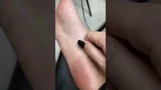 Кожа после пилинг носочков #бьютиблог #кожа #пилинг