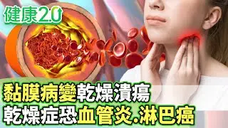 黏膜病變乾燥潰瘍 乾燥症恐血管炎.罹患淋巴癌【健康2.0分段】@tvbshealth20 EP3169-1 20260201 #鄭凱云#盧俊吉#蔡逸姍#吳明珠#洪素卿#林秋香