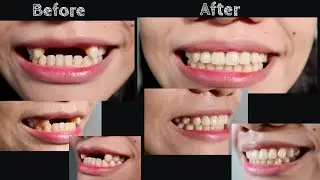 REMOVABLE PARTIAL DENTURE | Doc Noy