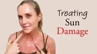 Cause & Treatment of constant redness on Neck and Chest (Poikiloderma of Civatte) | V beam laser