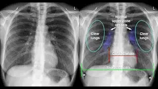Introduction to Chest X ray ; Anteroposterior view, Lateral view, Cardiothoracic ratio, cardiomegaly