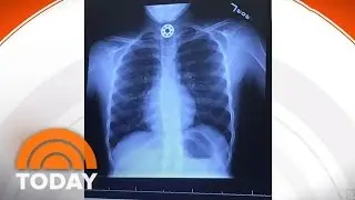 Fidget Spinner Parts Can Be Dangerous, Texas Mom Warns | TODAY