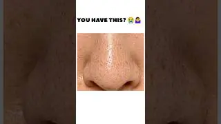 Instant Blackheads & Whiteheads removal remedy✨🤍#blackheads #remedy#glowup #beautytips #fypシ #shorts