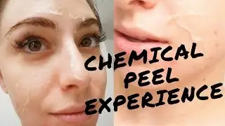 Результаты химического пилинга | Zo Peel | Джиа Виттория