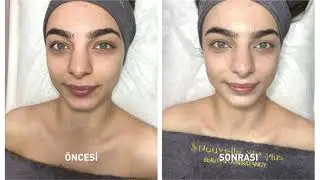 Hydrafacial Nedir? / Hydrafacial Nasıl Yapılır?