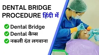 Dental Bridge Procedure Hindi |  Nakli Dant Lagwana | Artificial Dant lagwana | Dental Caps