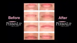 PermaLip Implants from Bella Vou