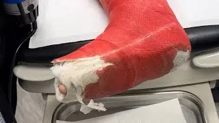Before and After: Cast application