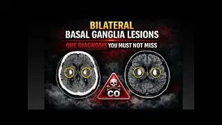 Bilateral basal ganglia lesions-One diagnosis you must not miss