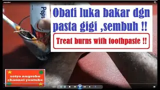 MENGOBATI LUKA BAKAR DENGAN PASTA GIGI / TREAT BURNS WITH TOOTHPASTE