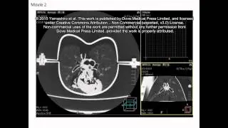 Continuous airway measurement on dynamic ventilation CT - Supplementary Video S2