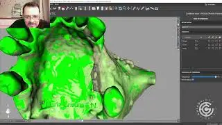 Métodos de comparação de tomografias pré e pós operatórias em implantodontia: 3D Slicer + Bluesky