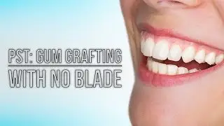 Pinhole vs. Traditional gum grafting - a less painful alternative