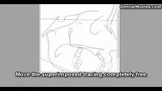 The software FACAD - Superimpose 2 tracings (8/9)